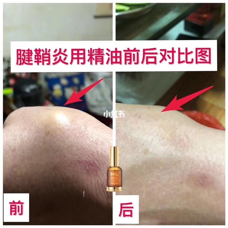 從疼痛到舒展 腱鞘炎精油的真實改善案例分享